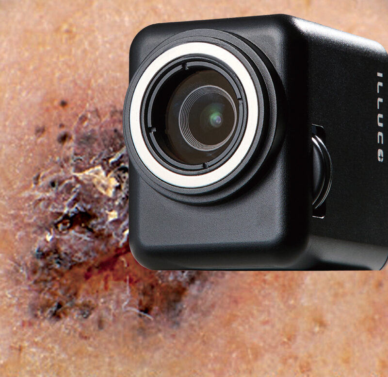ILLUCO IDC-1 LucoCam dermoscopy camera